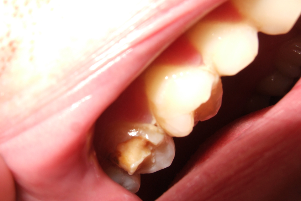 Anodija ant skaudančio danties kainavo teises ir baudą